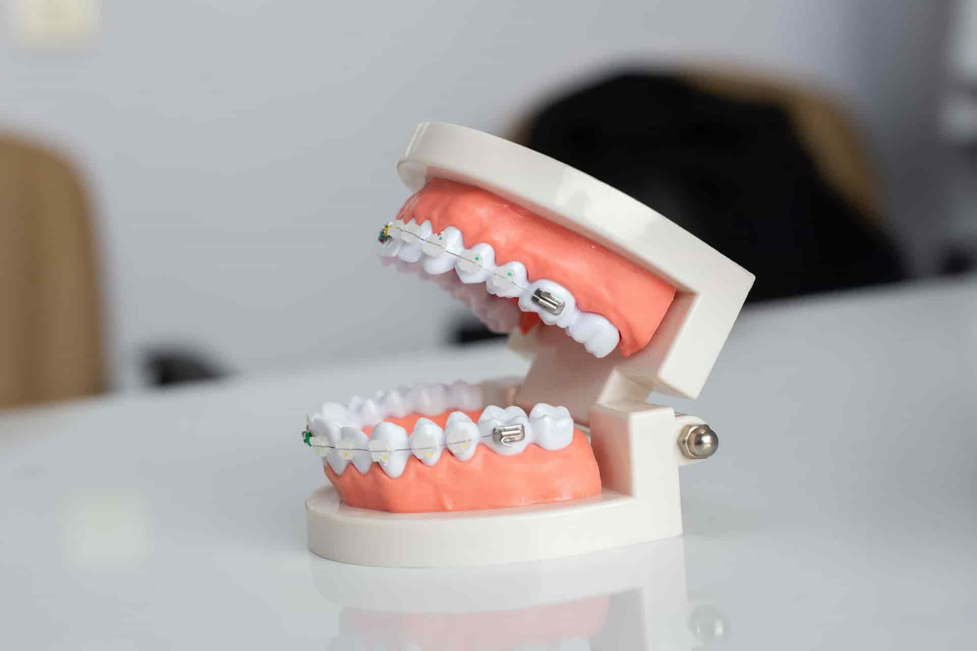 Bagues orthodontiques modernes — Cabinet Dr Misino Agen